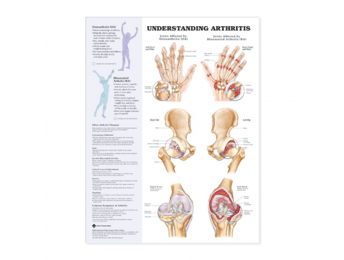 UNDERSTANDING ARTHRITIS ANATOMICAL CHART