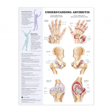 UNDERSTANDING ARTHRITIS ANATOMICAL CHART